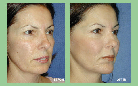 미국에서 많이하는 성형수술 세가지 | 인스티즈