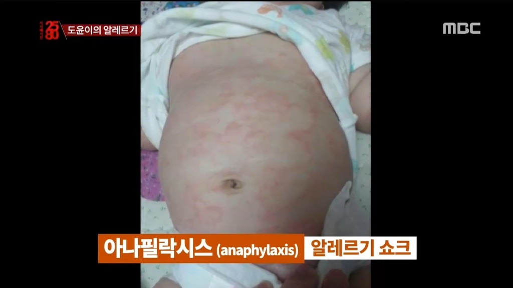 음식 알레르기로 고통받는 아이들.jpg | 인스티즈