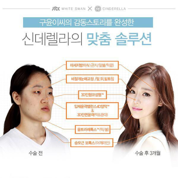 성형수술후 3개월 | 인스티즈