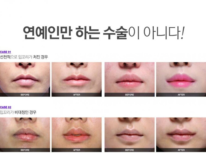 아주 잠깐 유행했던 성형수술 | 인스티즈